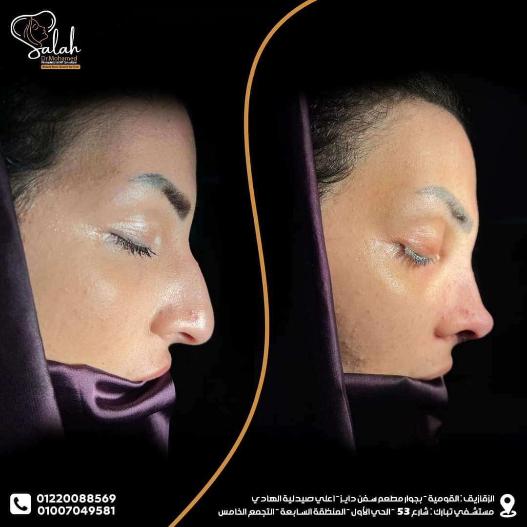 Droopy Tip Rhinoplasty